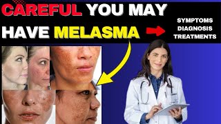 YOU COULD HAVE MELASMA AND NOT EVEN KNOW IT – SPOT THE SIGNS BEFORE IT’S TOO LATE [upl. by Modeste204]