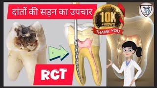 दांत में कीड़ा लगना  कारण लक्षण बचाव व उपचार  RCT  Root Canal Treatment  Tooth Cavity [upl. by Tsepmet]