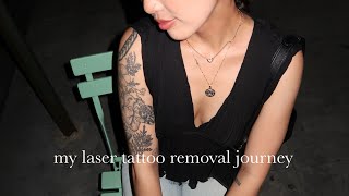 Laser Tattoo Removal in NYC Session 1 [upl. by Amandie]