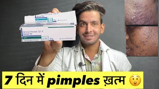 7 दिन में pimples ख़त्म 😲 Benzoyl peroxide gel 25  Benzoyl peroxide gel 25 how to use  Benzoyl [upl. by Eyahs144]