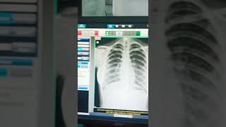 Chest X ray PA View [upl. by Elita]