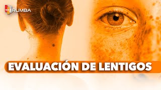 quotRevisión de Lentigos ¿Es Solo un Lentigoquot [upl. by Bergmans]