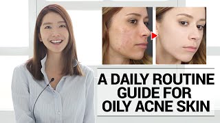 How to take care of Oily Acne Prone Skin A Daily Routine Guide  Wishtrend [upl. by Julie]