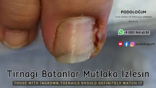 Tırnak Batması Olanlar Mutlaka İzlesinThose who have ingrown toenails should definitely watch this [upl. by Aleirbag]