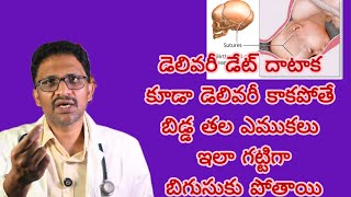 post dated pregnancy drkranthigynecologist డెలివరీ డేట్ తరువాత కూడా నొప్పులు రాకపోతే ఏమిఅవుతుంది [upl. by Nenad]