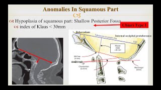 Craniovertebral Junction Anomalies Part 1 Occipital Anomalies Chiari Malformations [upl. by Peder908]