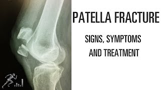 Patella fracture Mechanism of injury signs and symptoms and treatment [upl. by Ardiedal]