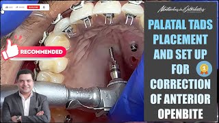 Palatal TADs Placement  Correction of Anterior Openbite  Miniscrews  MiniImplant  SAS  TAD [upl. by Nickelsen]