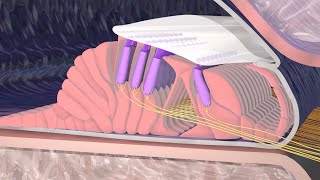 Hearing Loss Due to Nerve Damage [upl. by Aiclef]