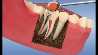 Reconstitution dentaire foulée￼ après dévitalisation molaire [upl. by Ri947]