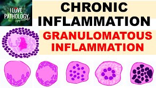 INFLAMMATION Part 9 Chronic Inflammation  GRANULOMATOUS INFLAMMATION [upl. by Bradstreet805]