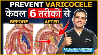 How To PreventAvoid Varicocele   Dr Gaurav Gangwani Interventional Radiologist [upl. by Amr]