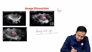 Endometrial Pathology USG Cases for NEET PG and FMGE Preparation by Dr Abhishek Jha [upl. by Magill]