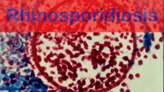 Rhinosporidiosis  Pathology mini tutorial [upl. by Odnala]