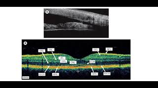 Kanski Clinical Ophthalmology Made Easy  Macula 5 A [upl. by Christis296]