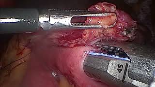 Revisional Single Anastomosis Sleeve Ileal Bypass [upl. by Kuebbing958]