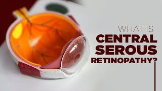 What is Central Serous Retinopathy  Symptoms Prevention Treatment and More [upl. by Giffard489]