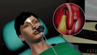 Balloon Sinus Surgery Animation [upl. by Eak]