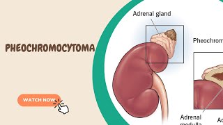 Pheochromocytoma [upl. by Novyaj]