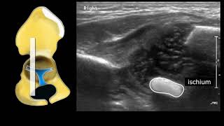 Congenital Hipdysplasia  Triradiate Cartilage [upl. by Lizzy]