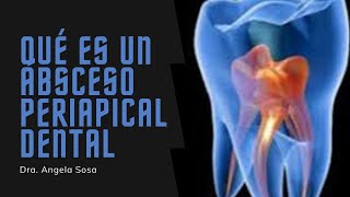 Que es un ABSCESO PERIAPICAL DENTAL [upl. by Phyl]