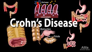 Crohns Disease Pathophysiology Symptoms Risk factors Diagnosis and Treatments Animation [upl. by Nilyarg413]