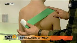 Cifoza la copii Ce facem [upl. by Griz]