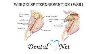 Wurzelspitzenresektion WSR ablauf [upl. by Ahsemad]