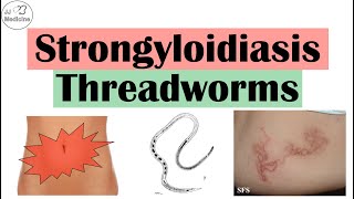 Strongyloidiasis Threadworms  Causes Pathophysiology Signs and Symptoms Diagnosis Treatment [upl. by Gladine]