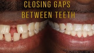 Closing Gaps Between Teeth With Braces [upl. by Suzette]