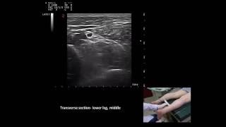 Ultrasound guided m tibialis posterior botulinum toxin injection by Murat Karkucak MD [upl. by Saltzman]