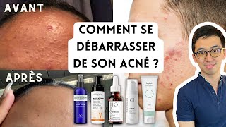 PEAU SANS ACNÉ  BOUTONS BLANCS OU ROUGES MICROKYSTES PLAQUES DE BOUTONS PAPULES PUSTULES [upl. by Kisor]