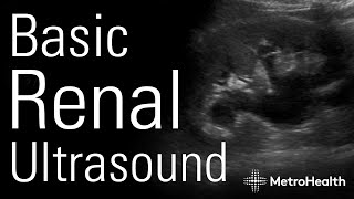 Basic Renal Ultrasound [upl. by Turner126]