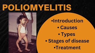 Poliomyelitis  Introduction Causes Stages of poliomyelitis diagnosis Treatment [upl. by Haidebej]