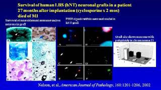 Stem Cell Therapy for Stroke  Gary Steinberg Stanford University [upl. by Flodnar]