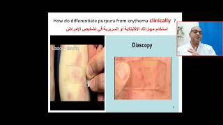 How to differentiate purpura from Erythema clinically is it Erythema or erythrocytes extravasation [upl. by Rape]