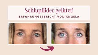 Schlupflider und Augenringe reduziert  Erfahrungsbericht von Angela [upl. by Anissej764]