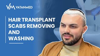 Hair Transplant Scabs Removing And Washing  VATANMED [upl. by Natalina]