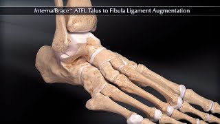 InternalBrace™ ATFL Talus to Fibula Ligament Augmentation [upl. by Aneehsal497]