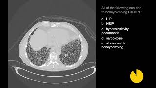 26 Cases of Interstitial Lung Disease  Xrays amp CT Scans [upl. by Daas]