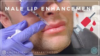 MALE LIP INJECTIONS  LIP FILLER FOR MEN by MOTYKIE MED SPA BARRINGTON [upl. by Lose42]