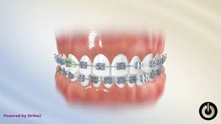 Elastics Midline UR3LL3  Dental Braces  Temecula Valley CA [upl. by Assiral751]