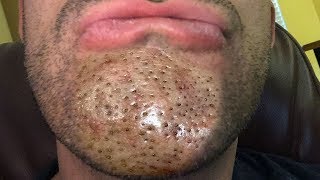 WARNING Blackheads amp Dilated Pores of Winer  Bubu Plus Documentary [upl. by Airehc405]