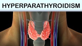 Hyperparathyroidism Medical Animation [upl. by Yatnahs]