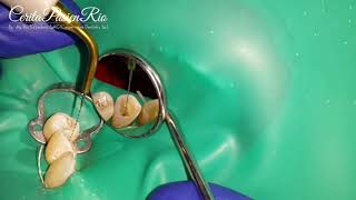 Endodontic Treatment Agitation of Irrigant with PUI  irrisafe perawatan saluran akar gigi [upl. by Eerpud656]