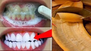 In Just 2minutes Whiten Yellow stained Teeth at Home BEST TEETH WHITENING REMEDY ll NGWorld [upl. by Aioj]