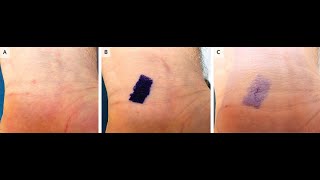 Burrow Ink Test für Scabies [upl. by Bradshaw]