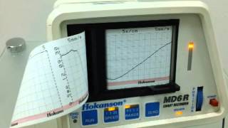 VENOUS PLETHYSMOGRAPHY Pletismografia venosa [upl. by Hnah]