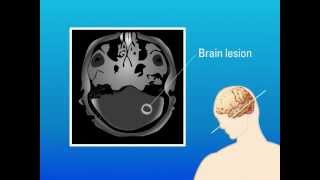 Extrapulmonary Aspergillosis – Type of Fungal Infection [upl. by Frederiksen]