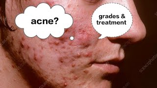 Acne Vulgaris  common problem [upl. by Annaiviv193]